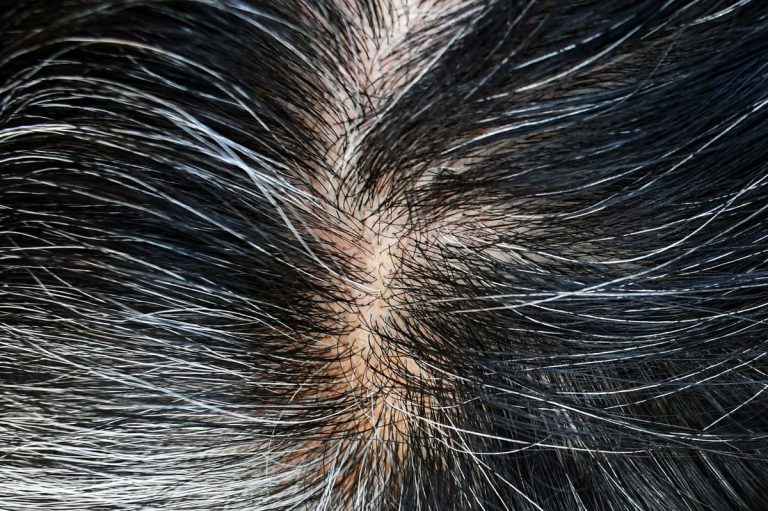 Comment enlever les pellicules sans se laver les cheveux ?